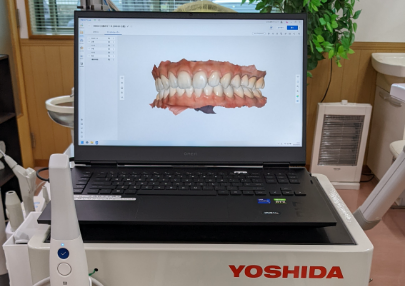 口腔内スキャナー