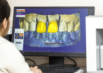 コンピューター上でスキャンデータを元に、技工物を設計します。